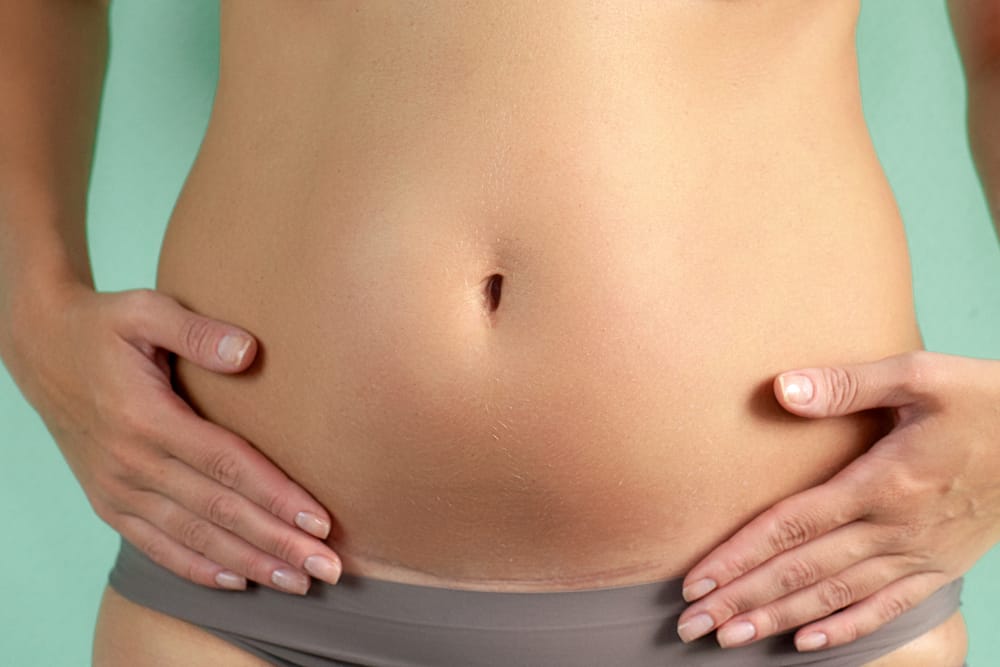 Gas Pains After C-Section - How to Deal With It