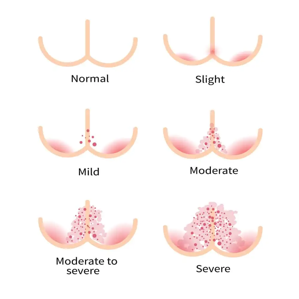 Diaper Rash Types