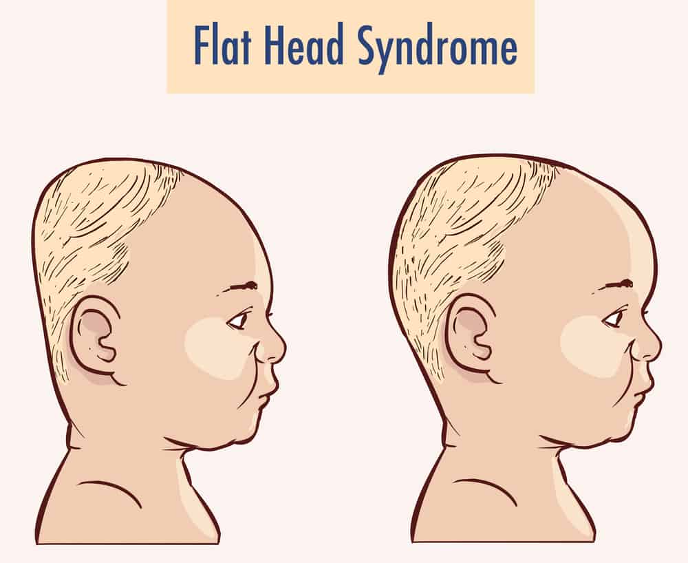Flat Head Syndrome Illustration