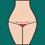 Illustration of woman with c-section