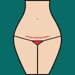 Illustration of woman with c-section