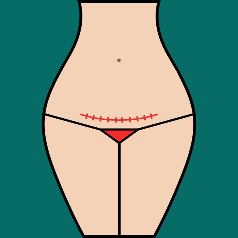 Illustration of woman with c-section