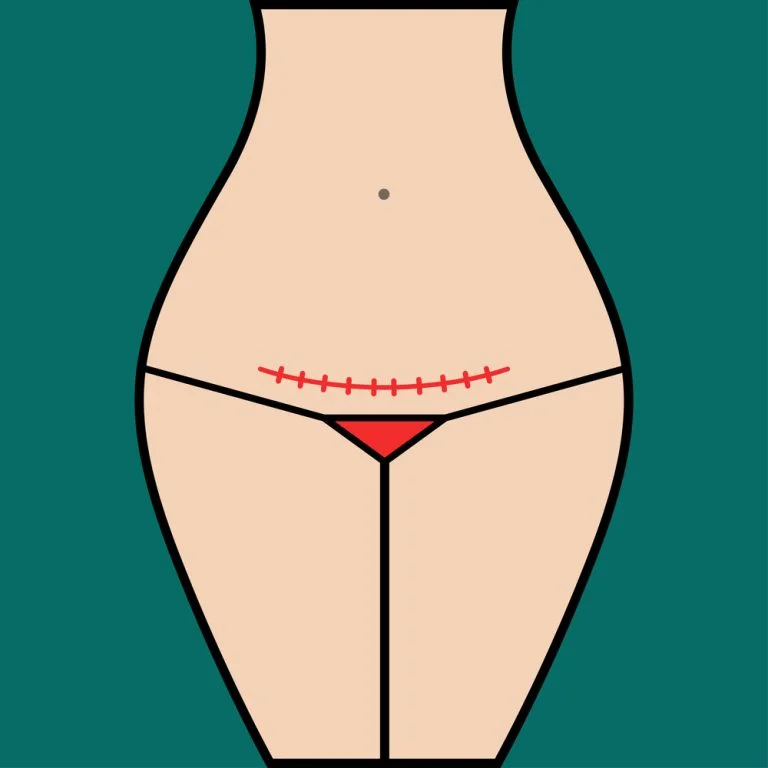 Illustration of woman with c-section
