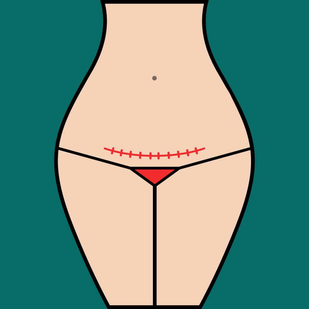 Illustration of woman with c-section