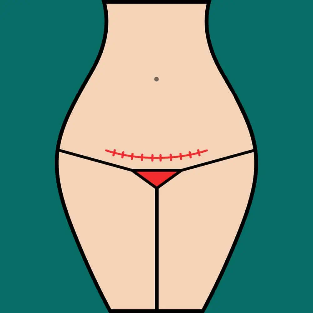 Illustration of woman with c-section