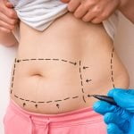 Plastic surgery doctor draw lines with black marker on patient belly for tummy tuck
