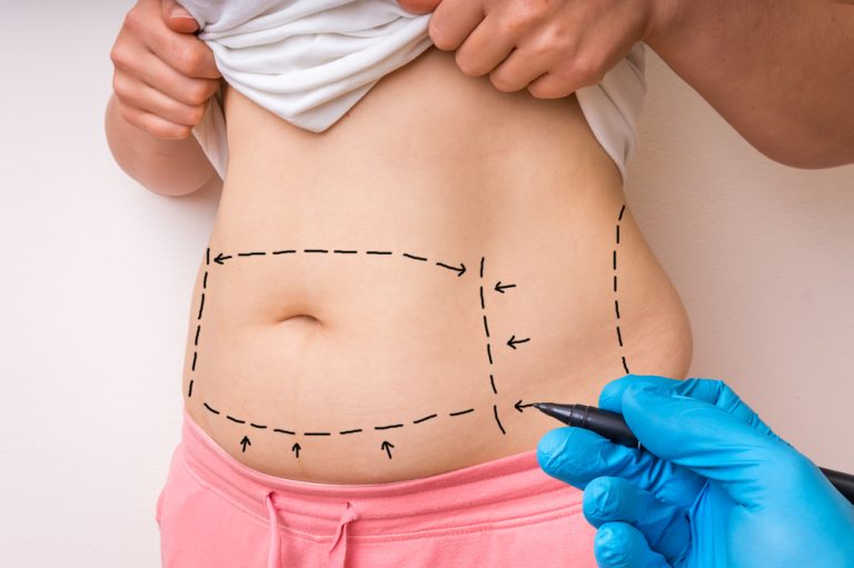 Plastic surgery doctor draw lines with black marker on patient belly for tummy tuck